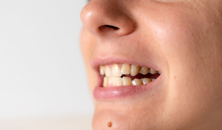 Eğer Bu Semptomlar Varsa Çiğneme Sisteminiz Bozulmuş Olabilir