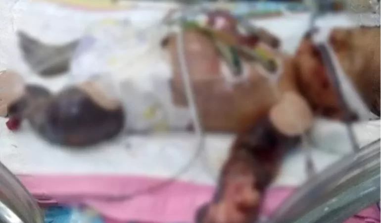 Erken Doğumun Akabinde Kuvöze Alınan Bebeğin Bedeni Morarmaya Başladı