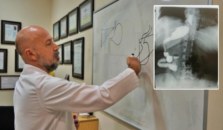Mide küçültme ameliyatına girdi, doktorlar şoke oldu: ‘Sıra dışı anatomik durum’