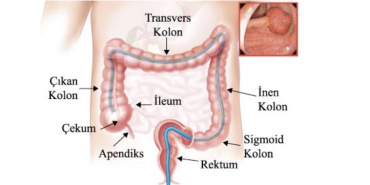 kalin-bagirsak-kanserinde-poliplerin-onemi-Ijj7OMem.jpeg