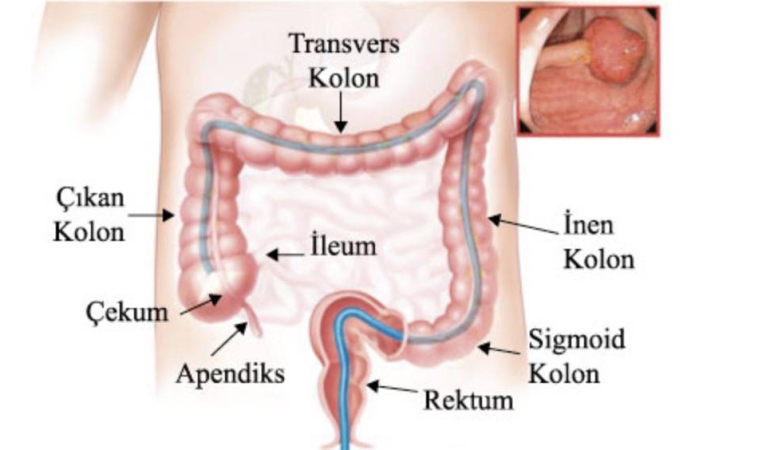 Kalın Bağırsak Kanserinde Poliplerin Önemi