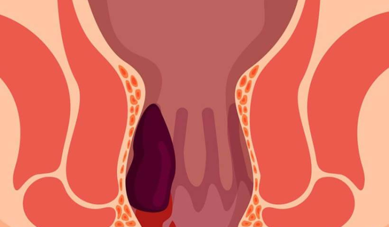 Tuvalette Telefon Alışkanlığı Hemoroid Yapabilir!